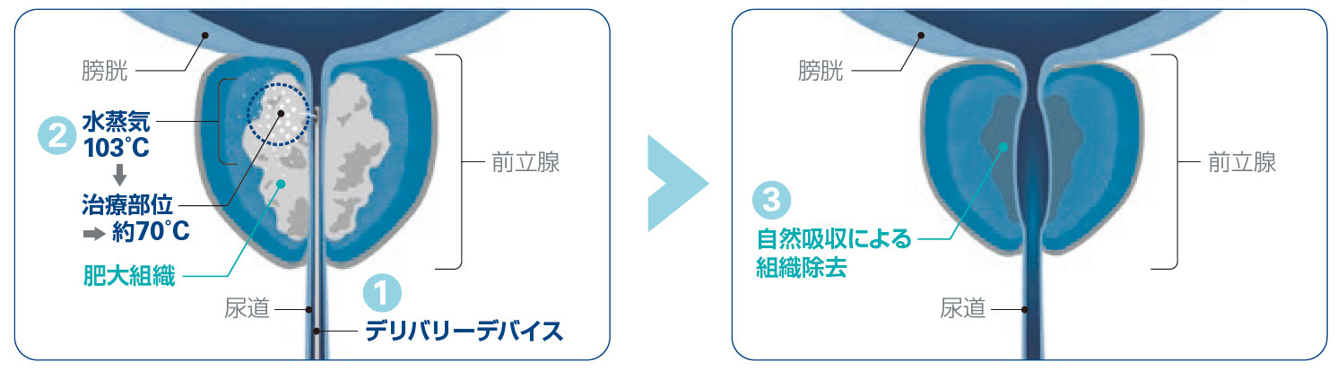 WAVE治療